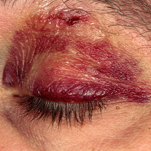 Eyelid laceration repair, Canalicular injury repair & Traumatic scar revision