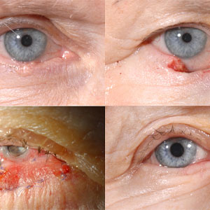 Eyelid swellings, Eyelid Tumor removal & eyelid reconstruction