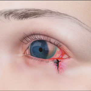 Ocular & Orbital Dermoid correction & Tumor management