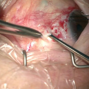 Orbitotomy for incision & excision biopsy