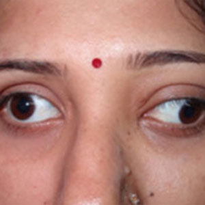 Thyroid eye disease management in Vijayawada