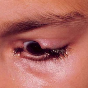 Congenital eyelid coloboma management
